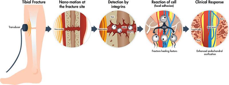 Illustration of how low-intensity ultrasound medical devices work to stimulate a biochemical response to enhance fracture repair.