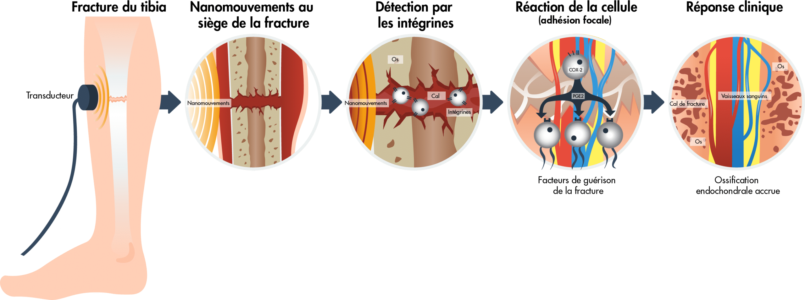 Illustration de la façon dont les appareils à ultrasons pulsés de faible intensité stimulent une réponse biochimique pour favoriser la réparation des fractures.